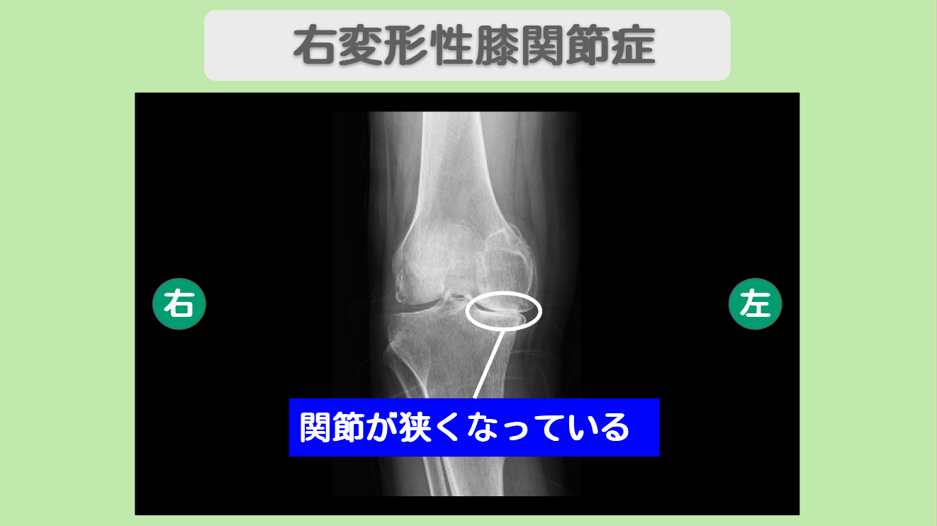 右変形性膝関節症　幹細胞治療