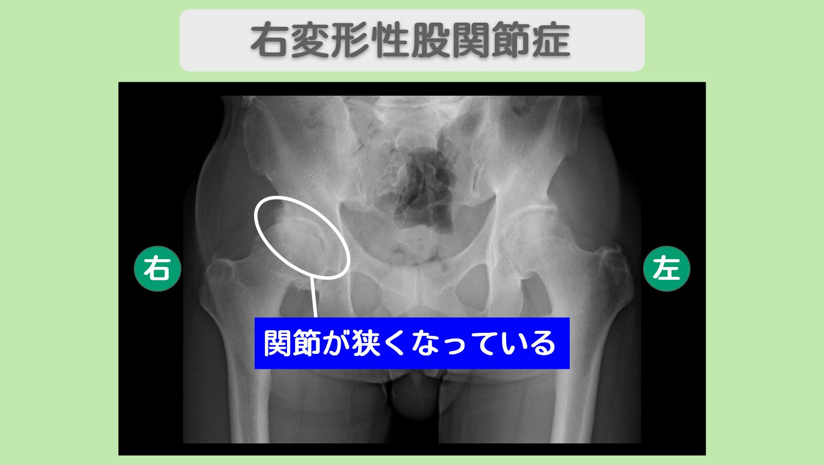 右変形性股関節症　幹細胞治療