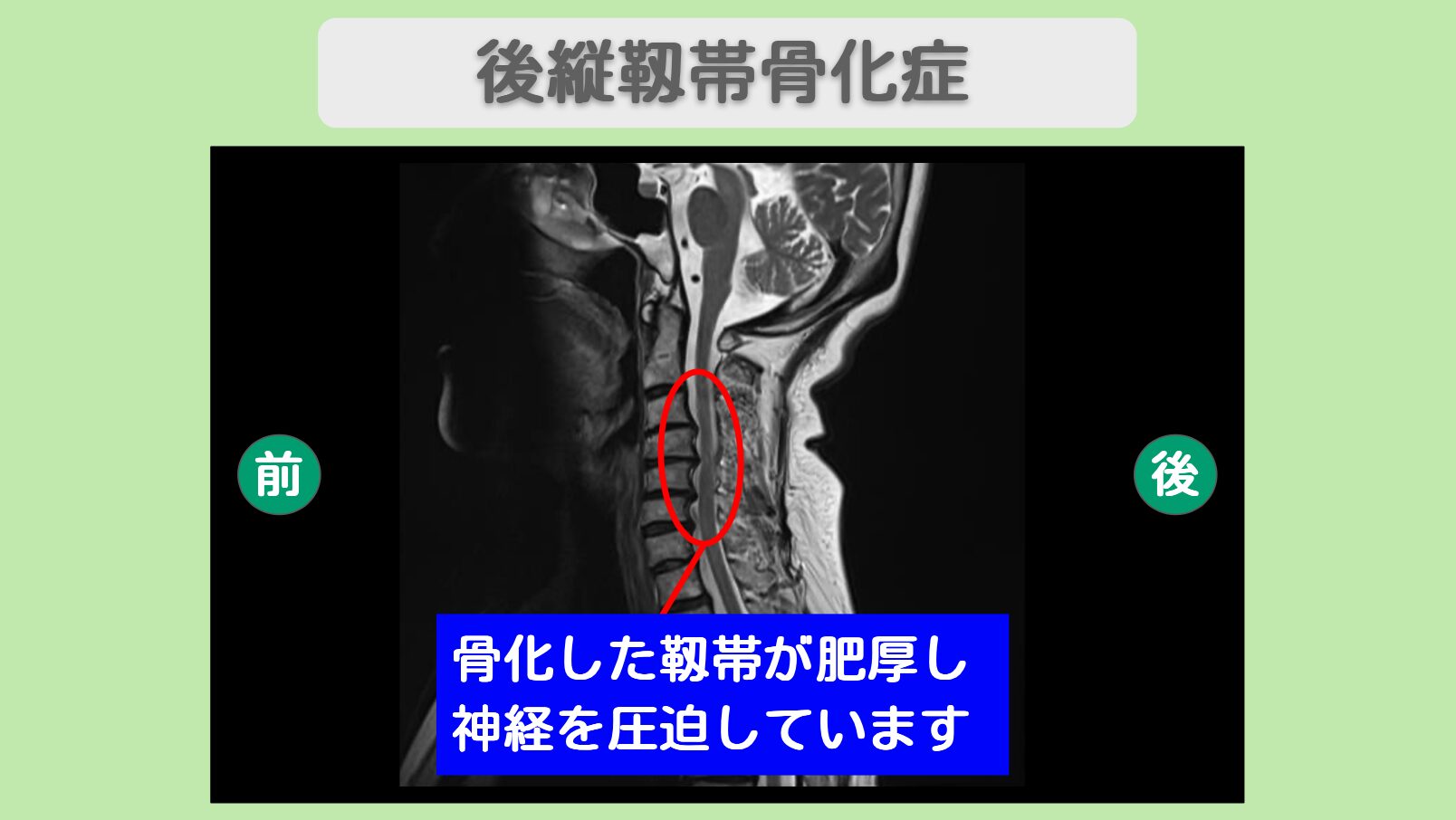 後縦靭帯骨化症　幹細胞治療