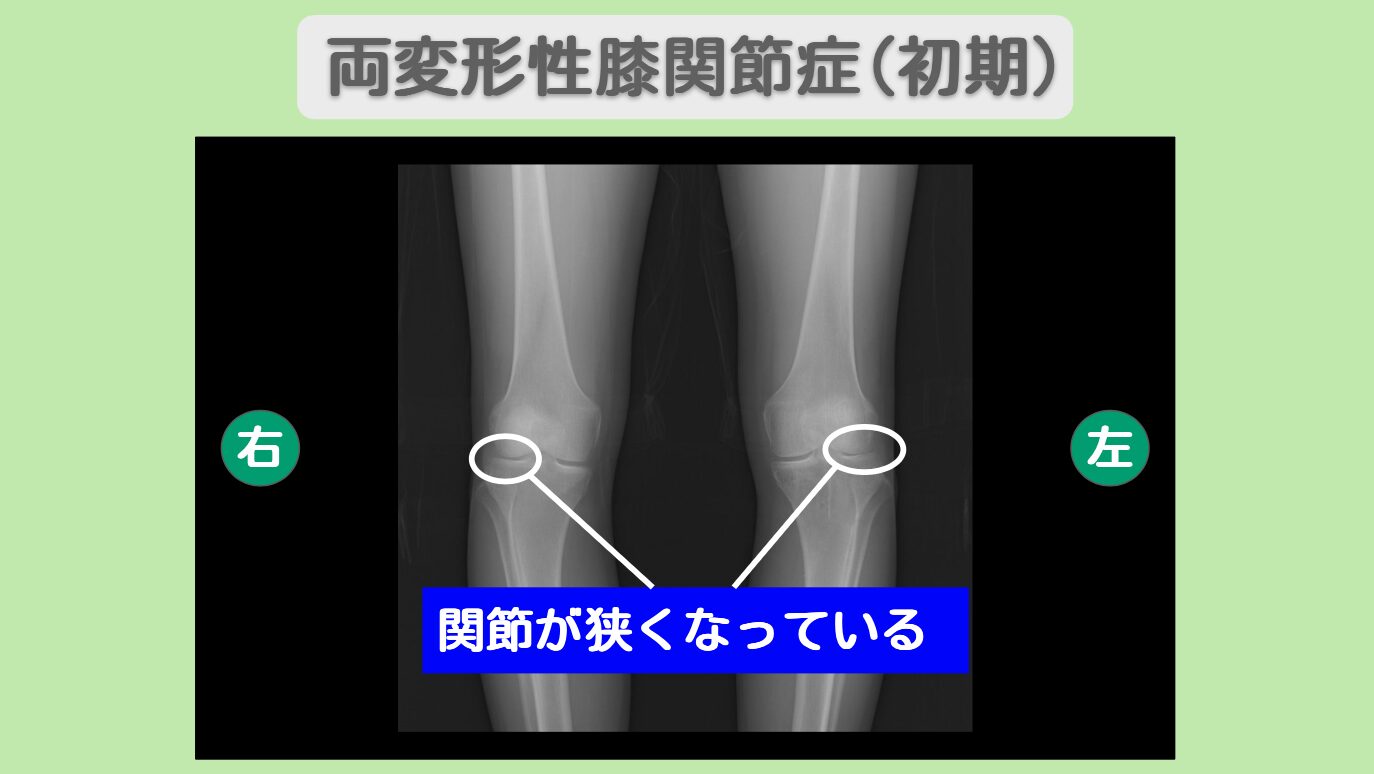 MRIにて左膝内側半月板の損傷がみられます。