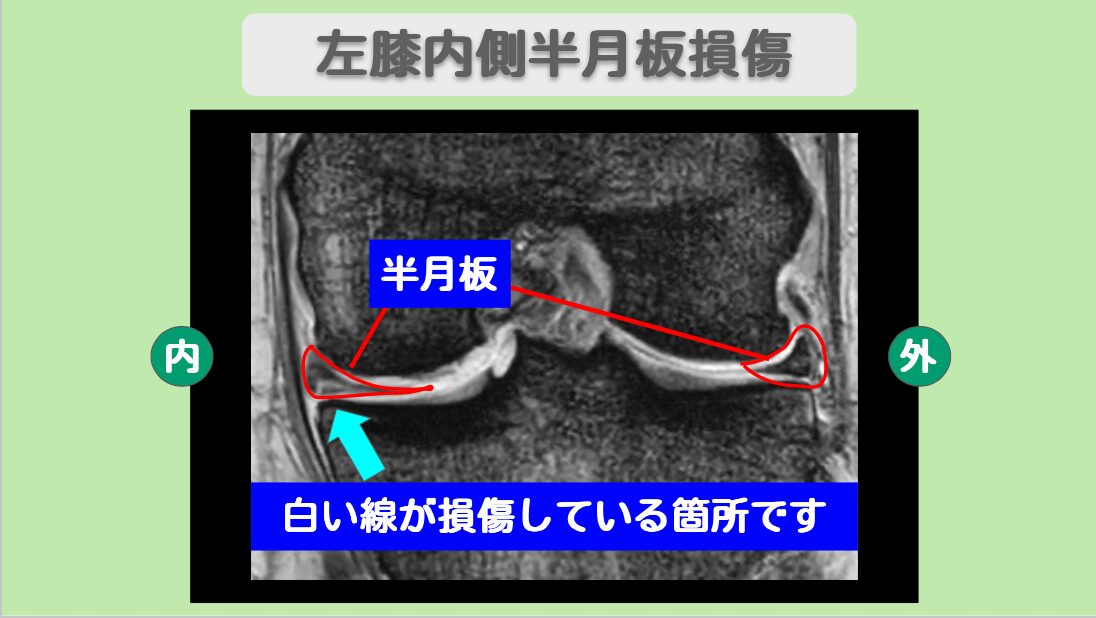 半月板損傷
