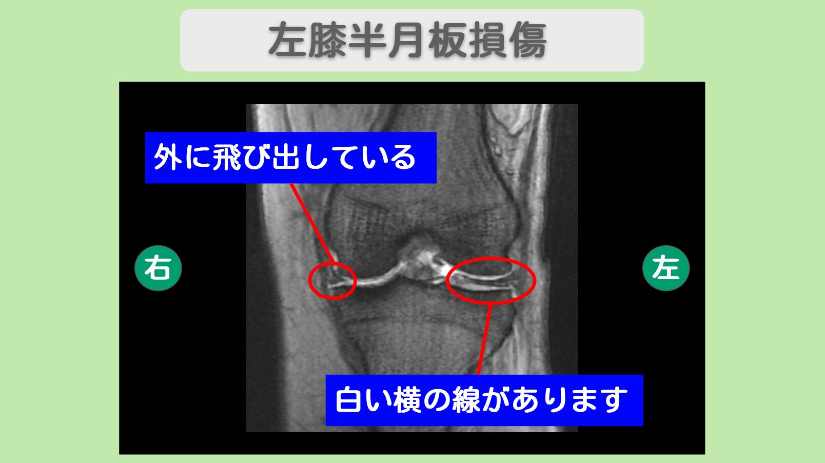 左半月板損傷　幹細胞治療　40代男性