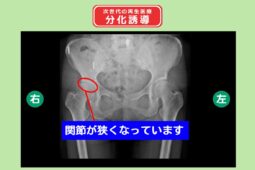右変形性股関節症　分化誘導　幹細胞治療