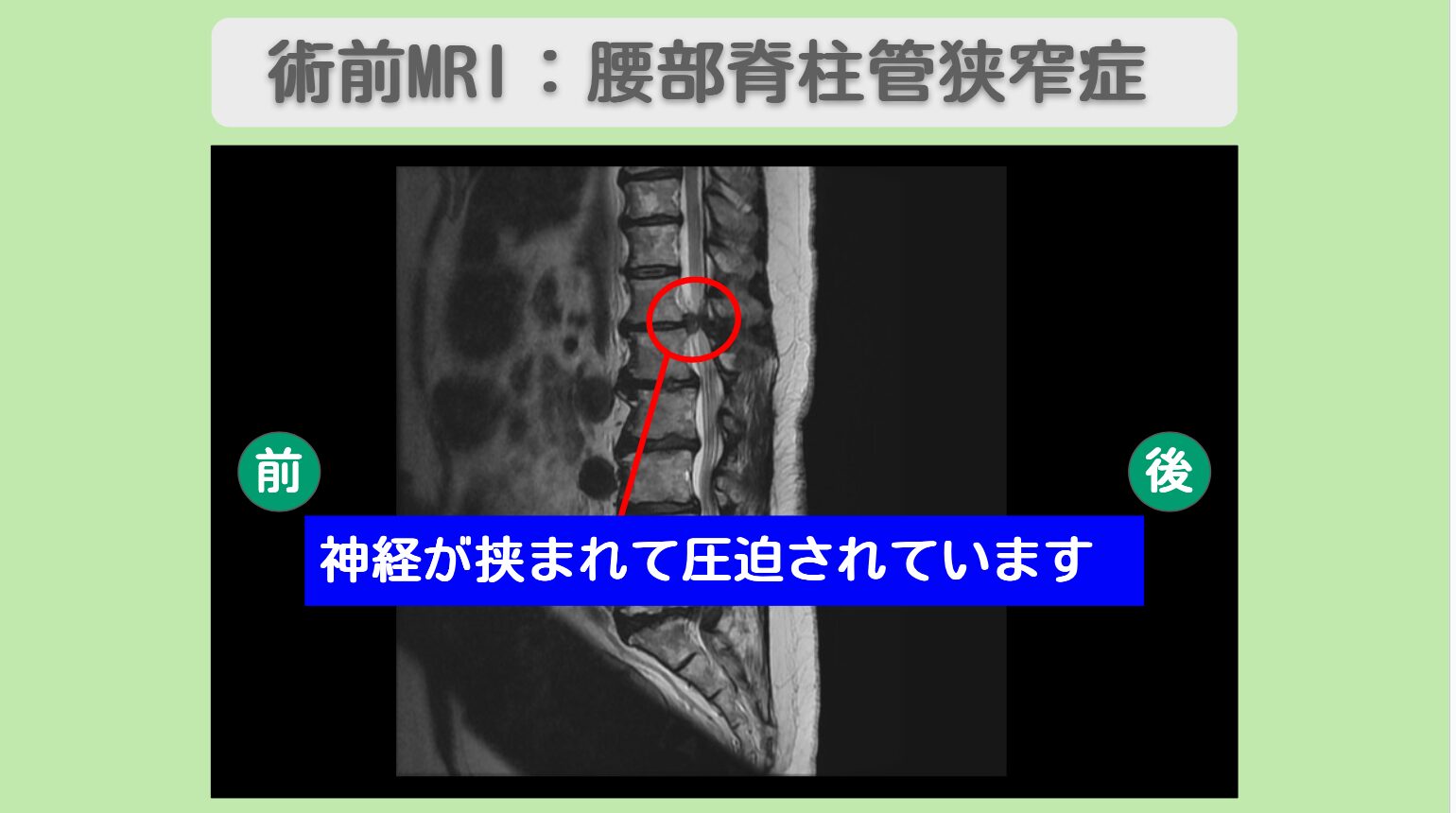 腰部脊柱管狭窄症術後　幹細胞治療