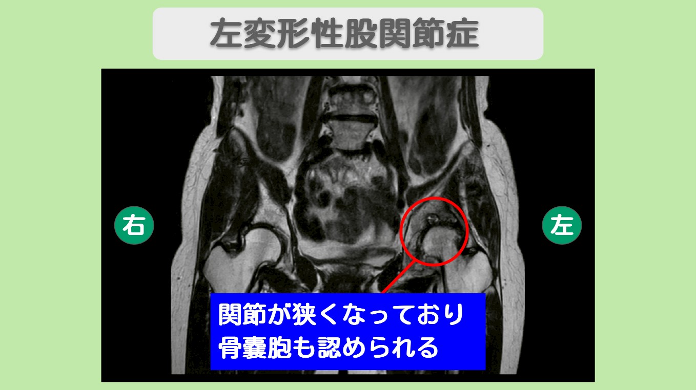 左変形性股関節症