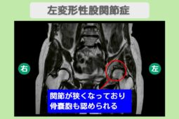 左変形性股関節症