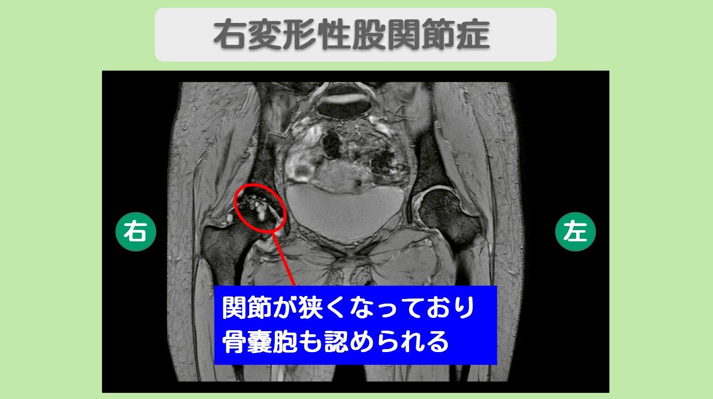 変形性股関節症　幹細胞治療