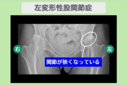 左変形性股関節症（臼蓋形成不全、臼蓋骨嚢胞）　幹細胞治療