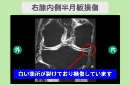 半月板損傷　幹細胞治療