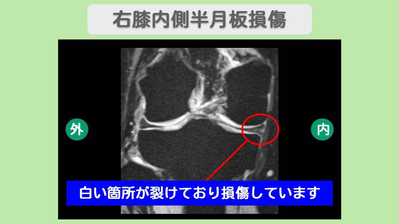 半月板損傷　幹細胞治療