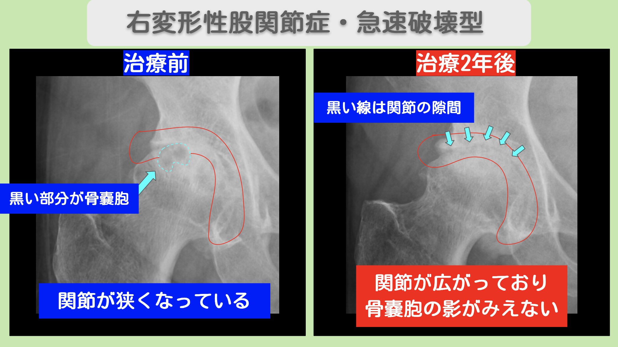 右変形性股関節症・急速破壊型