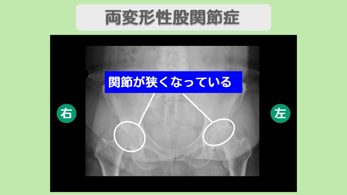 変形性股関節症　幹細胞治療