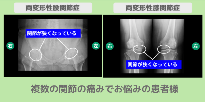 両変形性股関節症・両変形性膝関節症 幹細胞治療