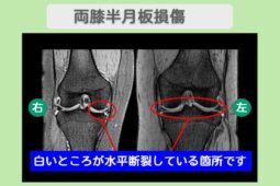 両膝半月板損傷　肝細胞治療