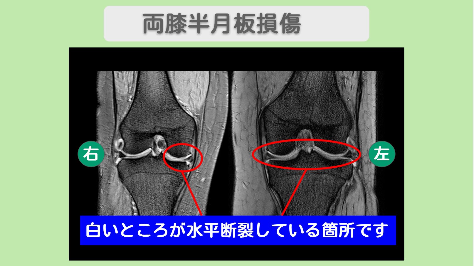両膝半月板損傷 肝細胞治療