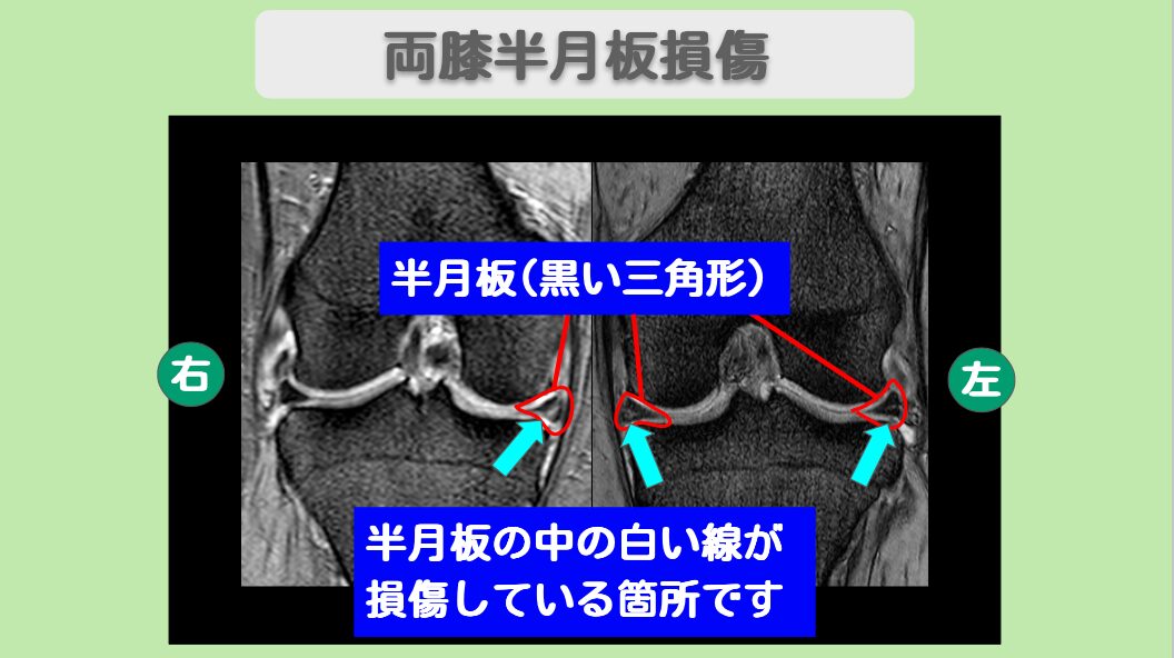 半月板損傷