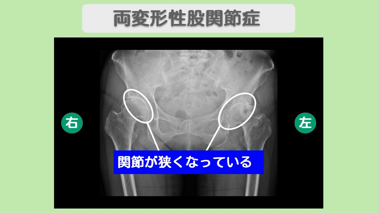 変形性股関節症