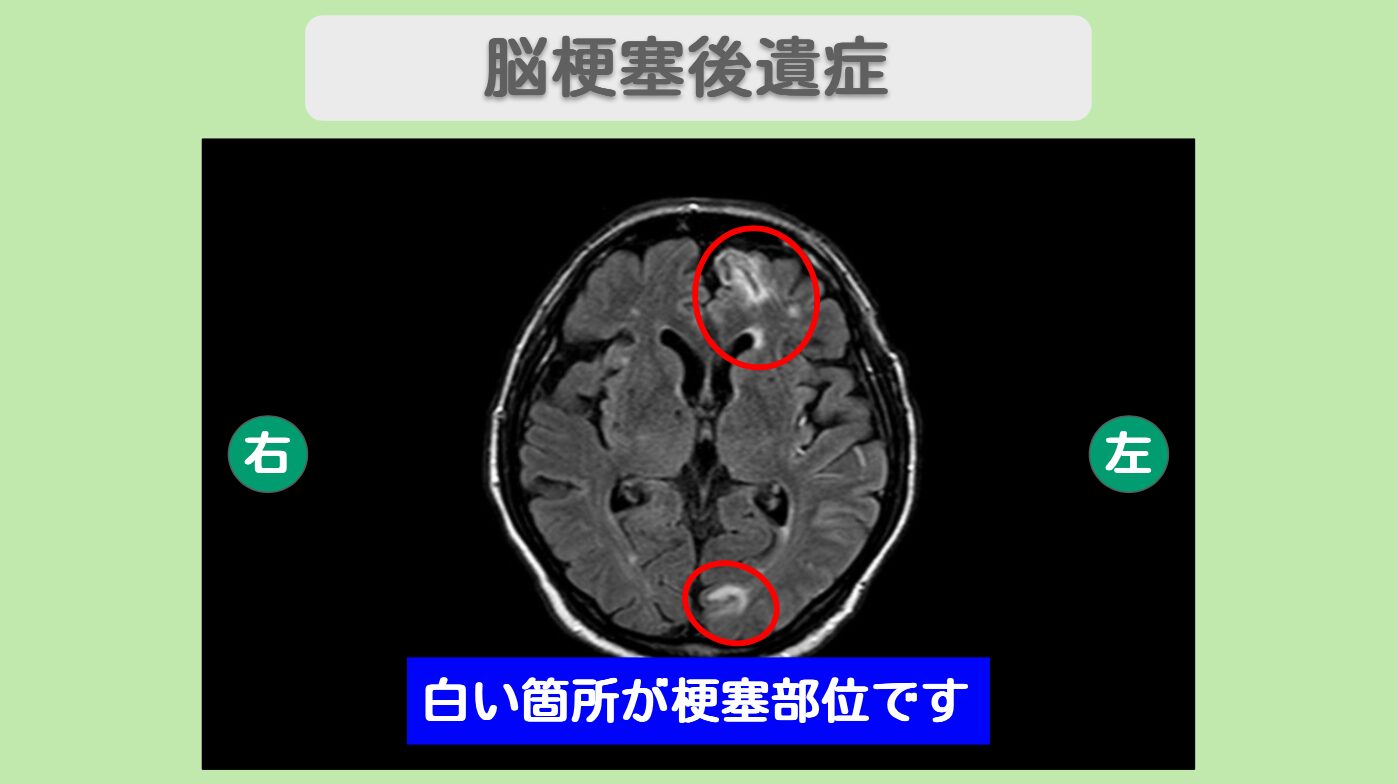 脳梗塞　幹細胞治療