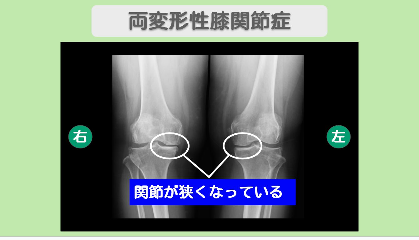 変形性膝関節症　幹細胞治療