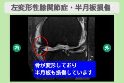 左変形性膝関節症　幹細胞治療