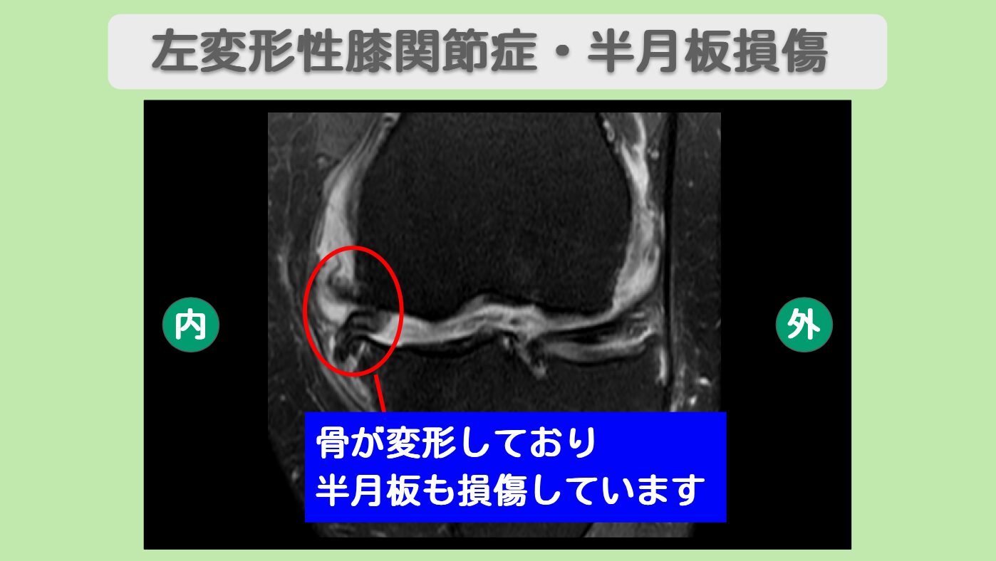 左変形性膝関節症 幹細胞治療