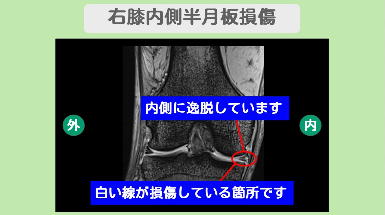両膝半月板損傷 幹細胞治療