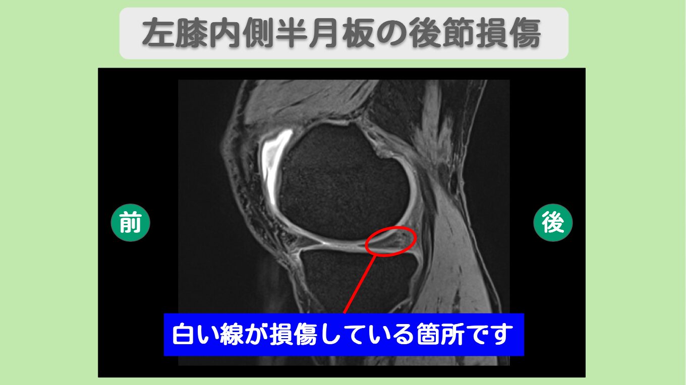 両膝半月板損傷 幹細胞治療