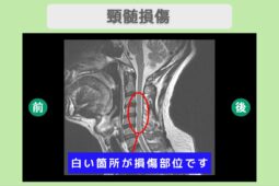 頚髄損傷　幹細胞治療