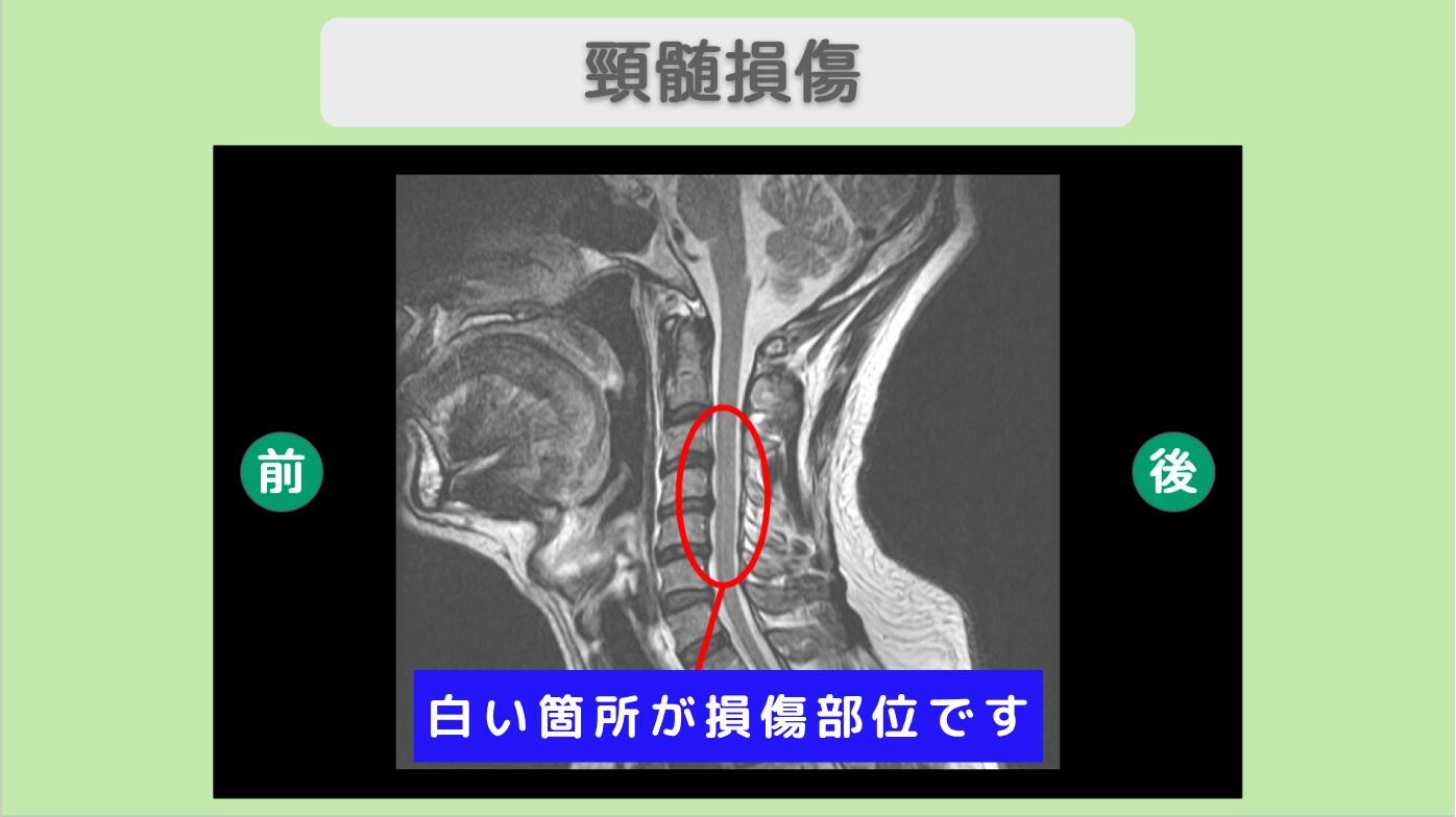 頚髄損傷 幹細胞治療
