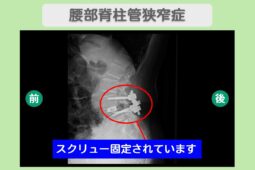 腰部脊柱管狭窄症　幹細胞治療