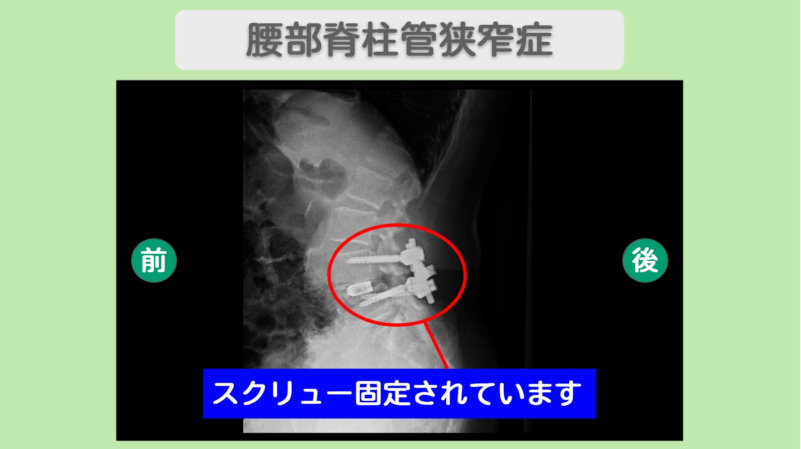 腰部脊柱管狭窄症　幹細胞治療
