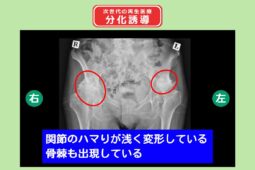 両変形性股関節症　分化誘導　幹細胞治療