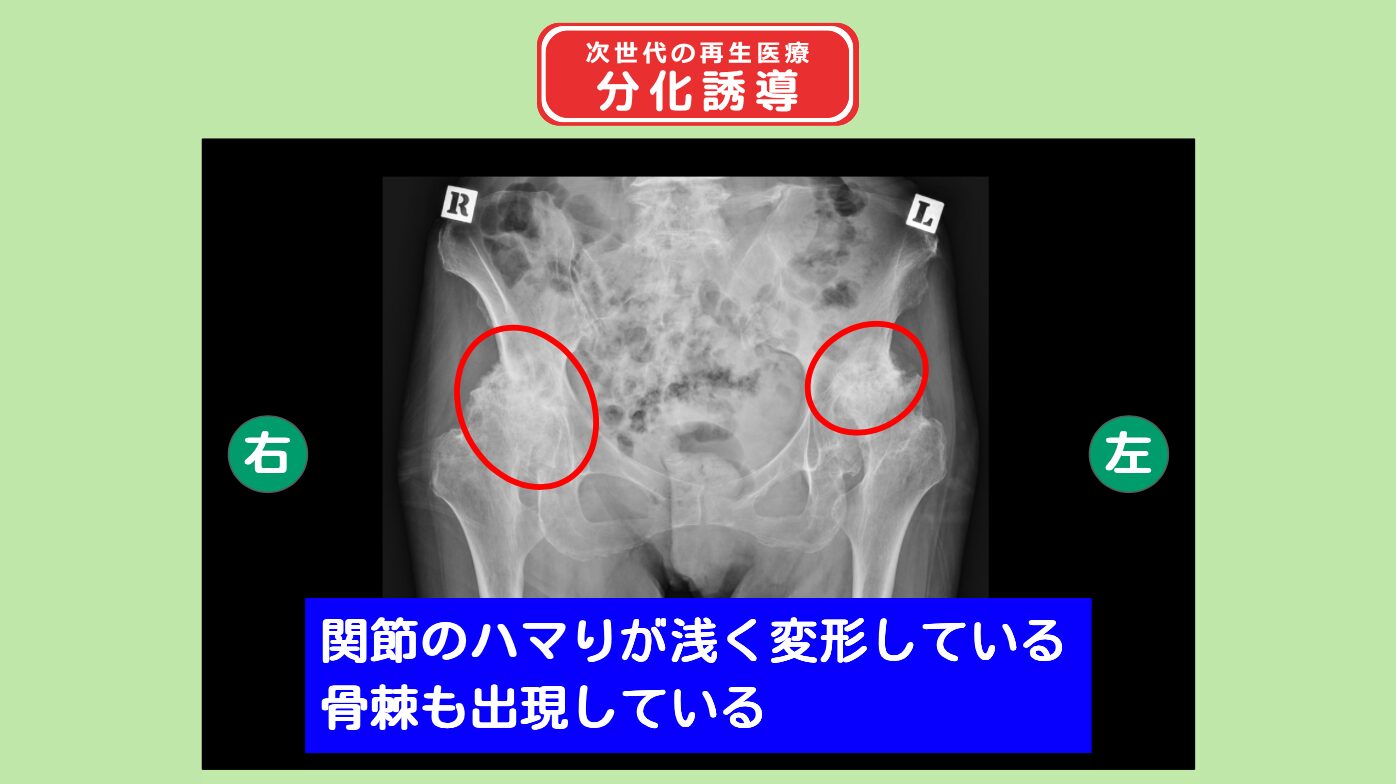 両変形性股関節症 分化誘導 幹細胞治療