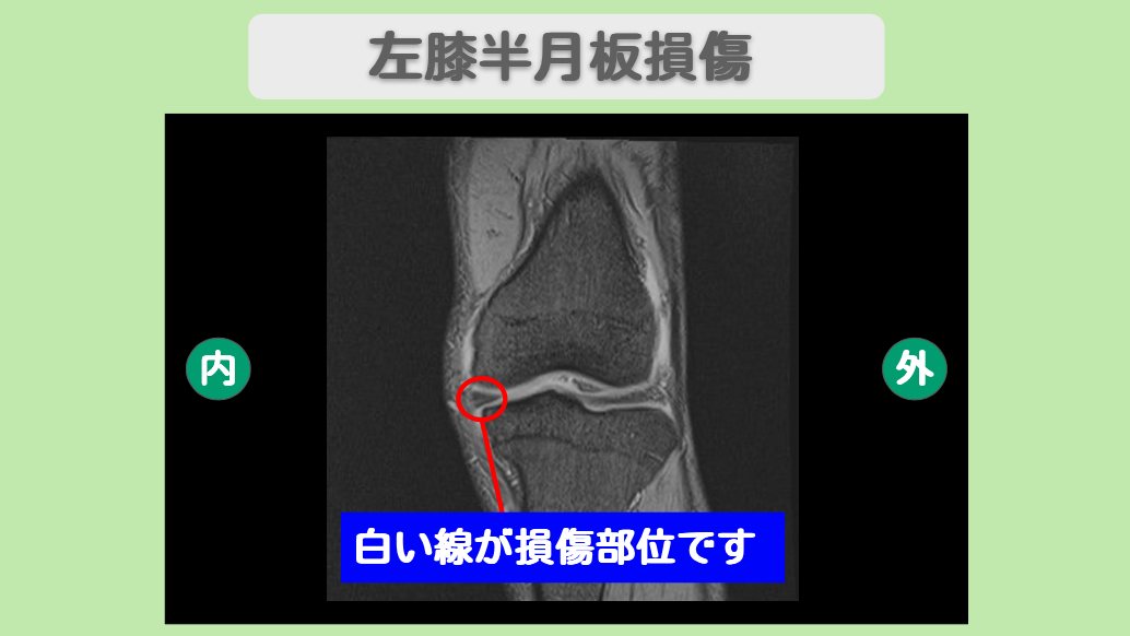 左膝半月板損傷　幹細胞治療
