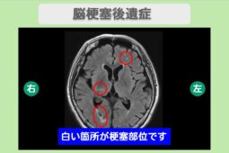 脳梗塞　幹細胞治療