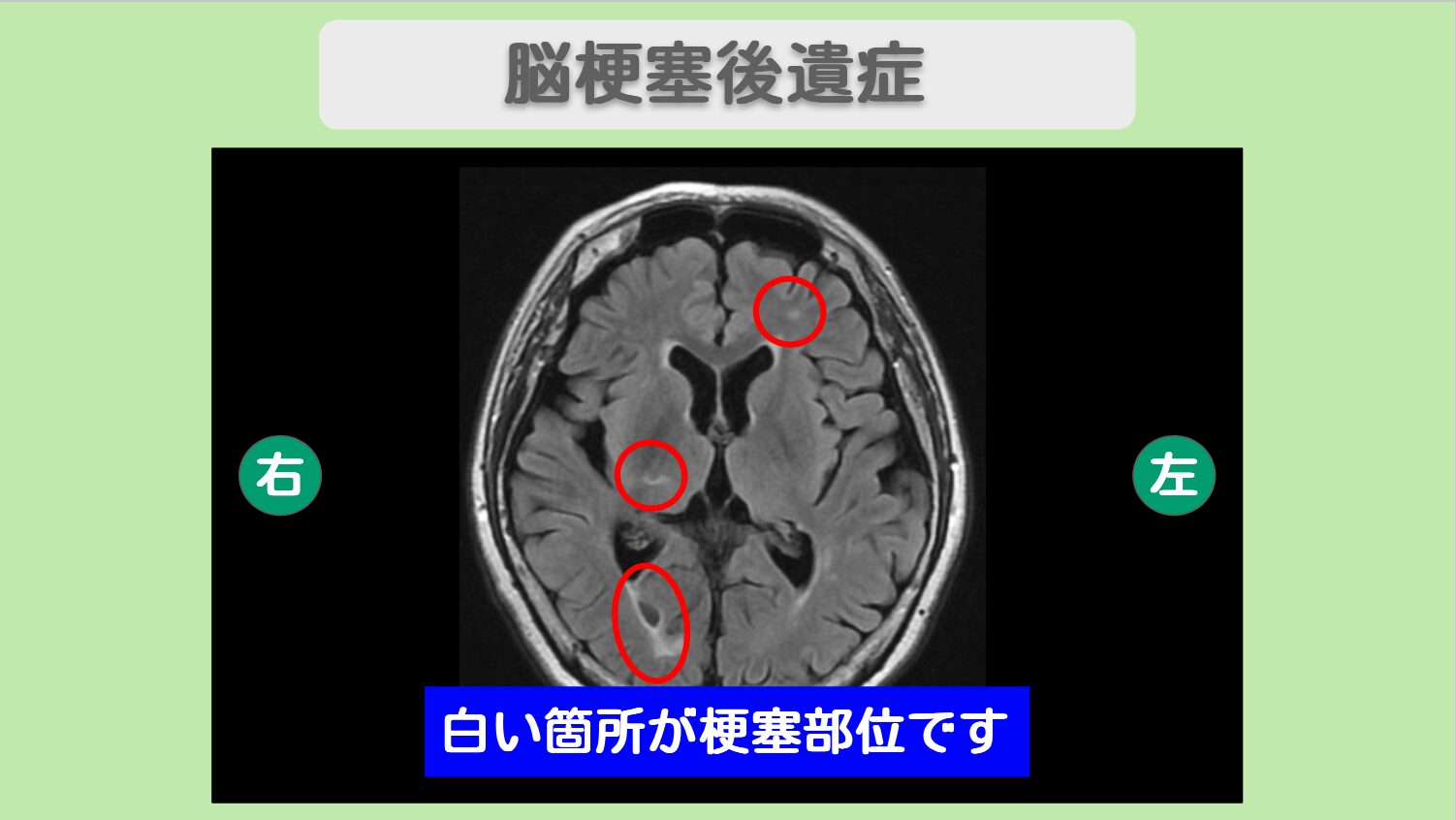 脳梗塞 幹細胞治療