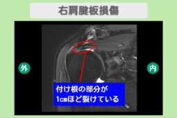 右肩腱板損傷