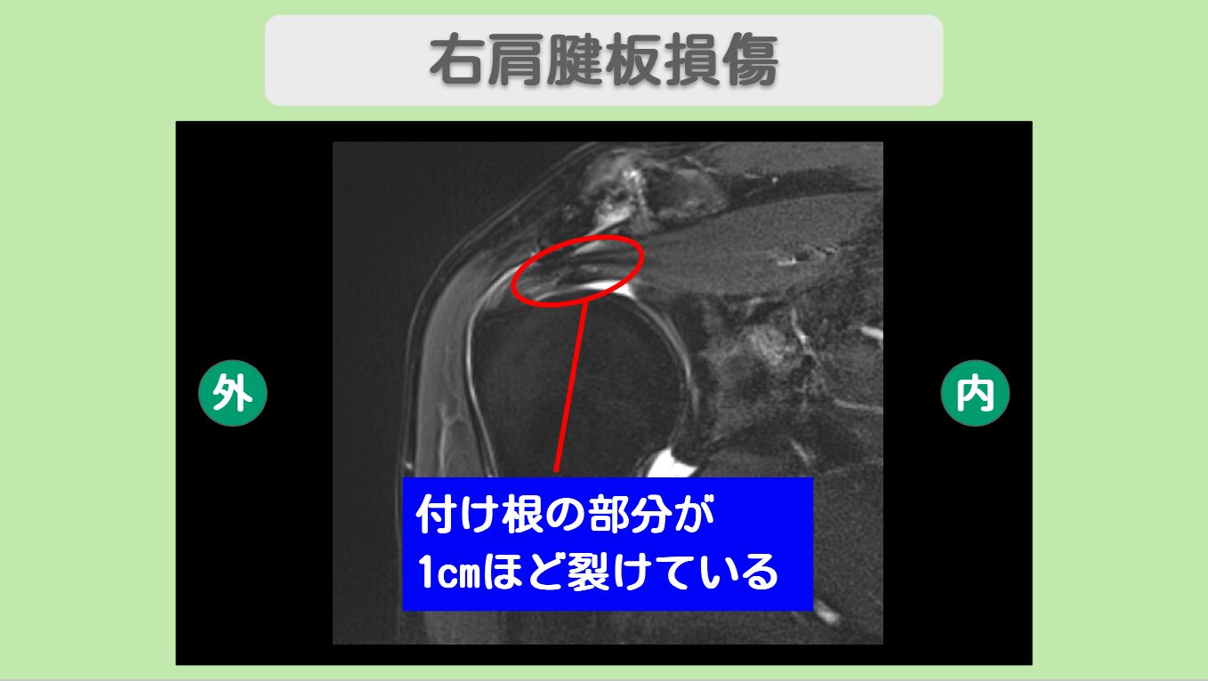 右肩腱板損傷