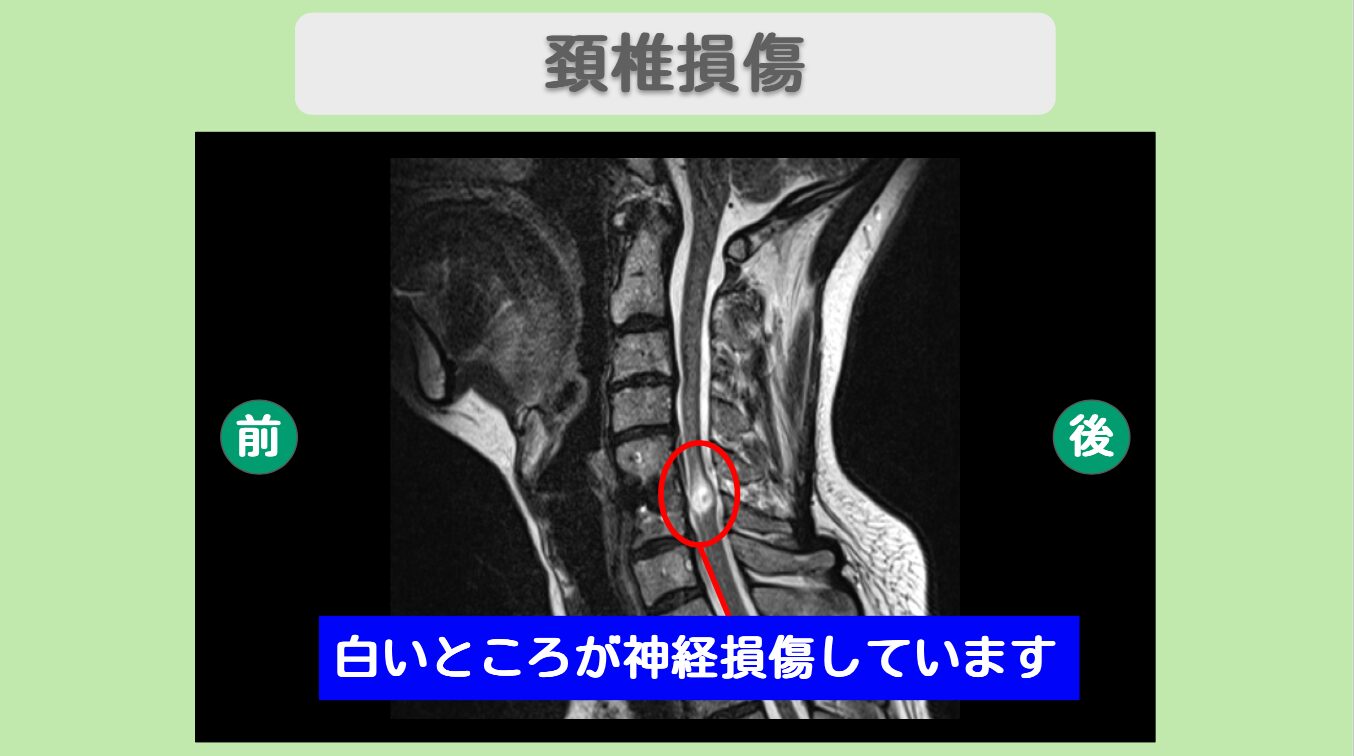 頚髄損傷