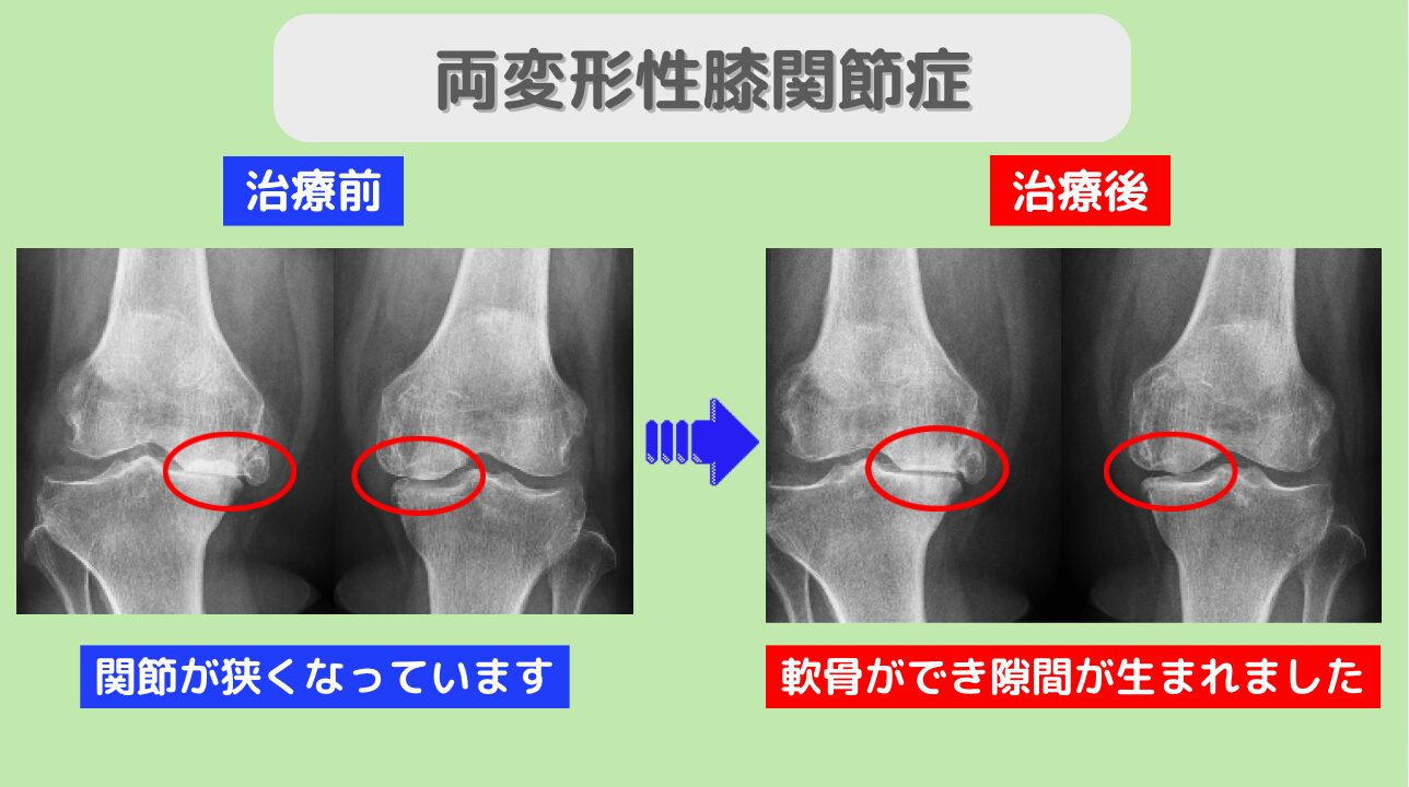 両変形性膝関節症