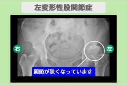 左変形性股関節症