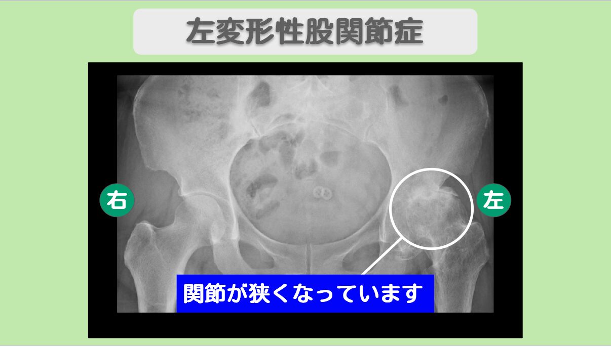 左変形性股関節症