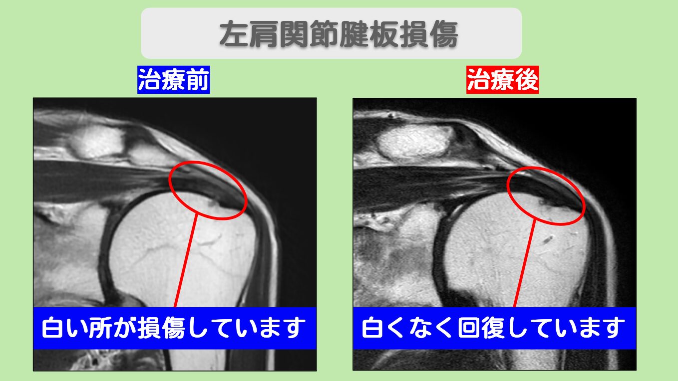 左肩腱板損傷　幹細胞治療