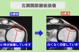 肩関節腱板損傷　ビフォーアフター