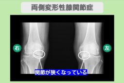 変形性膝関節症