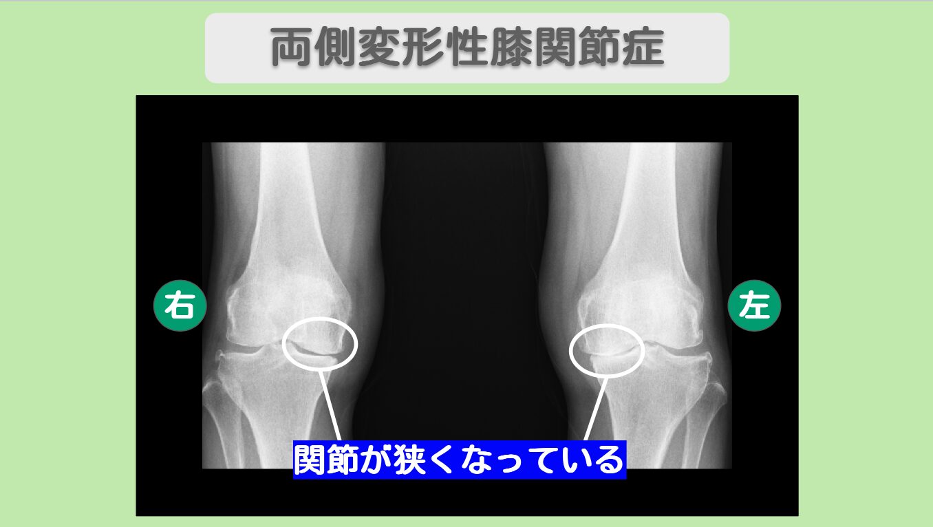 変形性膝関節症