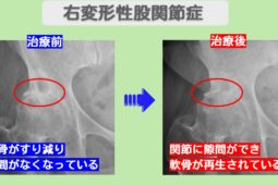 右変形性股関節症
