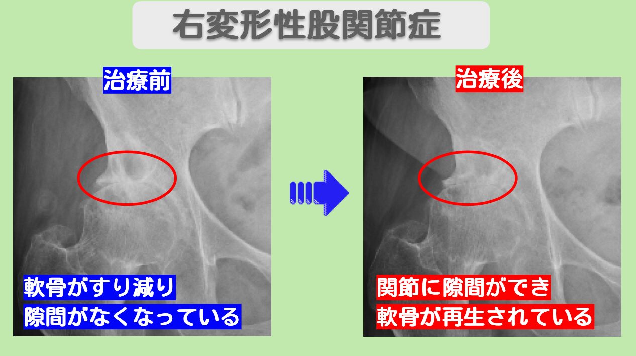 右変形性股関節症