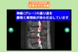 腰椎脊柱管狭窄症
