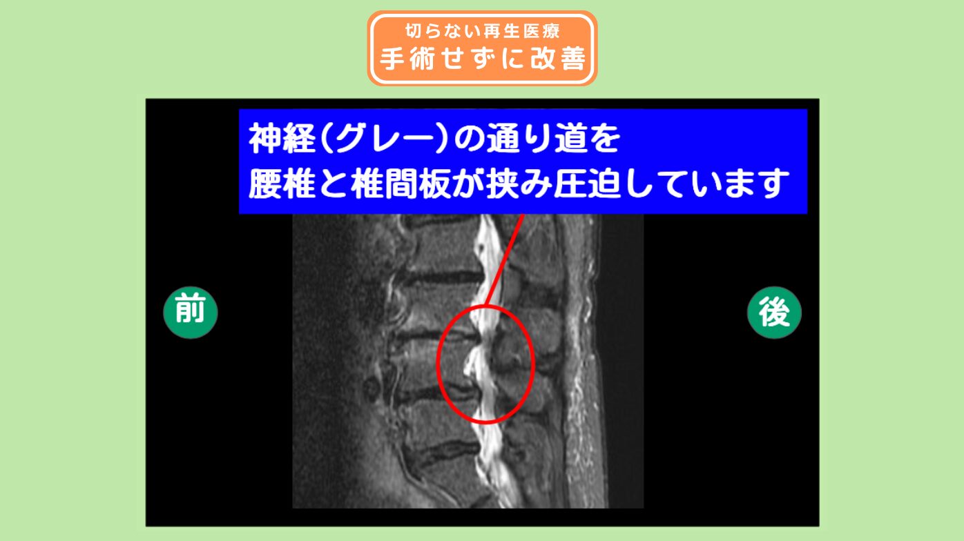 腰椎脊柱管狭窄症